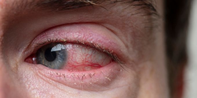 Corneal Ulcer Eye Treatment Essex