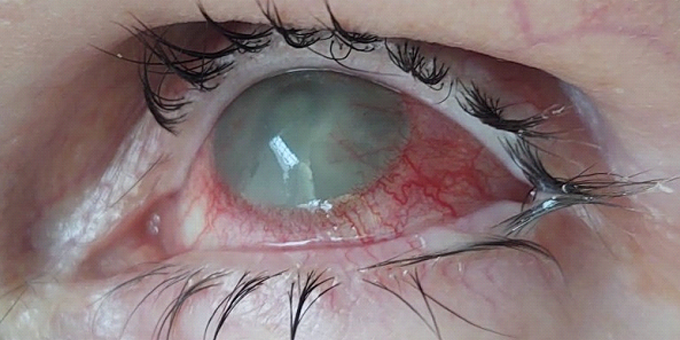 Corneal Ulcer Eye Treatment Essex