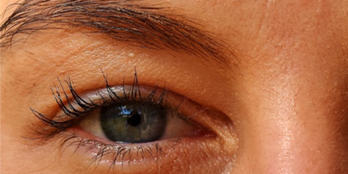 Symptoms of a Corneal Ulcer