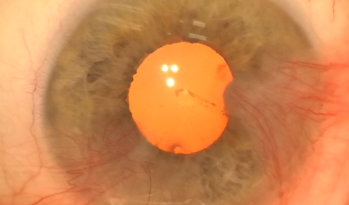 Another pterygium