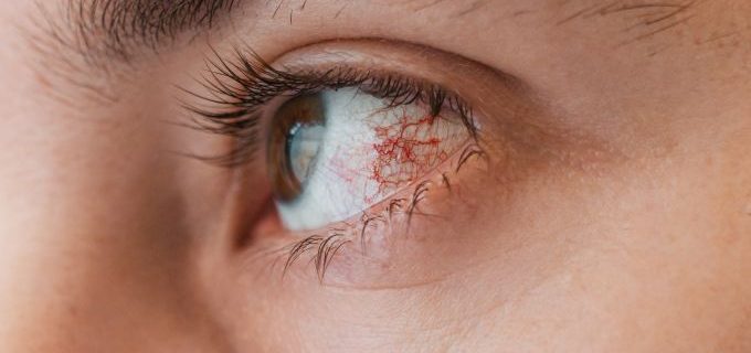 Corneal Ulcer