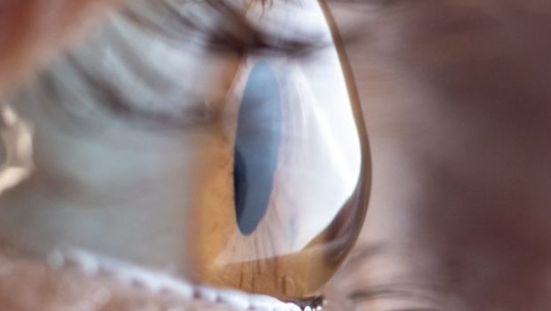 Keratoconus 2 (1)