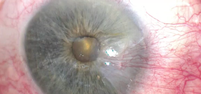 pterygium